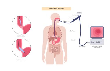 Endoskopik pnömatik genişleme. Üst endoskopi minimum invaziv prosedür. Yemek borusunda bozukluk, akhalasya tedavisi. Balon, kapalı yemek borusu sfinkterisindeki kas liflerini bozar.