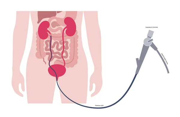 Ureteroscopy Minimally Invasive Procedure Examination Treatment Kidney Disorder Urinary System — Stock Vector