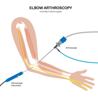 Dirsek eklemi minimal invaziv ameliyat. Artroskopi tıbbi prosedürü. Kol kemiği, dirsek kemiği ve ön kol kemiği anatomisi. Kol ağrısı, kırık, osteoartrit veya romatoid artrit x ışını çizimi