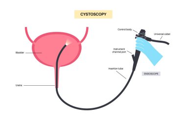 Cystoscopy is a minimally invasive procedure. Examination and treatment of the bladder. Disorder of the urinary system, cancer, polyps, stones or inflammation. Urinary tract medical poster flat vector clipart