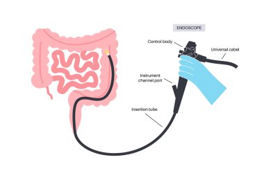 Kolonoskopi asgari invaziv bir işlemdir. Kalın bağırsağın muayene ve tedavisi. Kalın bağırsak düzensizliği, polipler, iltihap ya da bağırsak şişmesi. Gastrointestinal bozukluk düz vektör