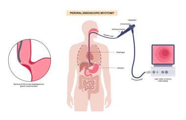 Peroral endoskopik miyotomi. Şiir, minimal invaziv prosedür. Yemek borusunda bozukluk, akhalasya hastalığı. Kapalı özofajiyal sfinkter, gastroözofajiyal anatomik poster çizimi