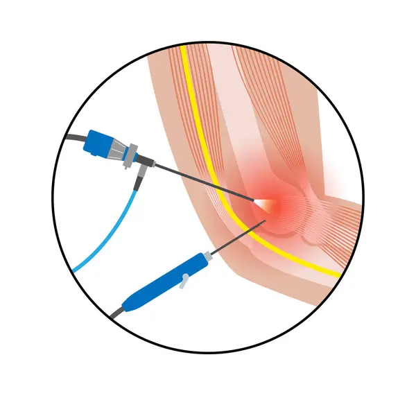 Cirurgia Minimamente Invasiva Articulação Cotovelo Procedimento Médico Artroscopia Anatomia Úmero —  Vetores de Stock