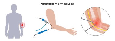 Dirsek eklemi minimal invaziv ameliyat. Artroskopi tıbbi prosedürü. Kol kemiği, dirsek kemiği ve ön kol kemiği anatomisi. Kol ağrısı, kırık, osteoartrit veya romatoid artrit x ışını çizimi