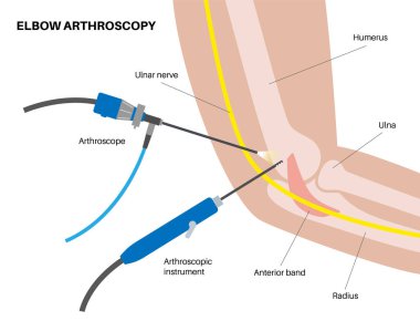 Dirsek eklemi minimal invaziv ameliyat. Artroskopi tıbbi prosedürü. Kol kemiği, dirsek kemiği ve ön kol kemiği anatomisi. Kol ağrısı, kırık, osteoartrit veya romatoid artrit x ışını çizimi