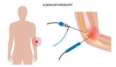 Dirsek eklemi minimal invaziv ameliyat. Artroskopi tıbbi prosedürü. Kol kemiği, dirsek kemiği ve ön kol kemiği anatomisi. Kol ağrısı, kırık, osteoartrit veya romatoid artrit x ışını çizimi