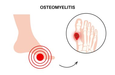 Kemik iltihabı hastalığı. Enfekte olmuş ayak kemikleri, acı ve kızarıklık. Enfeksiyon kan dolaşımından ayağına yayılır. Staphylococcus aureus bakterisi insan vücut vektörü çiziminde