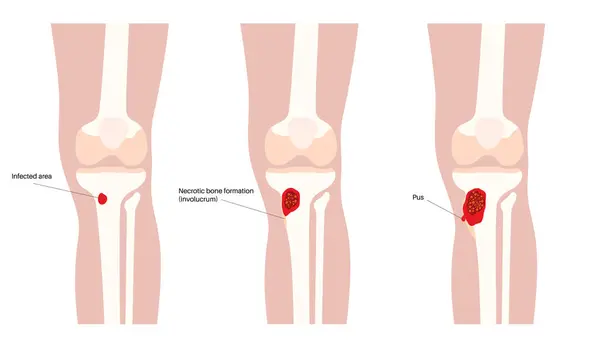 肝炎の病気について 感染した膝 死んだ骨 過度の赤み 感染症は血流を通してチビアに広がります 人体ベクターイラストにおけるステフィロコッカスのオークレウス菌 — ストックベクタ