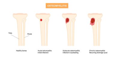 Kemik iltihabı hastalığı. Enfeksiyon kapmış diz, ölü kemikler, acı ve kızarıklık. Enfeksiyon kan dolaşımından kaval kemiğine yayılır. Staphylococcus aureus bakterisi insan vücut vektörü çiziminde