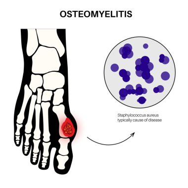 Kemik iltihabı hastalığı. Enfekte olmuş ayak kemikleri, acı ve kızarıklık. Enfeksiyon kan dolaşımından ayağına yayılır. Staphylococcus aureus bakterisi insan vücut vektörü çiziminde