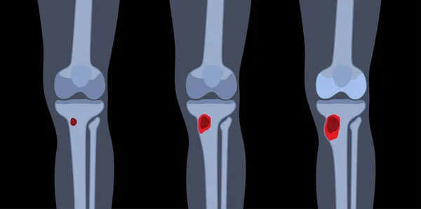 Osteomyelitis Befallene Knie Abgestorbene Knochen Schmerzen Und Darüber Liegende Rötungen — Stockvektor