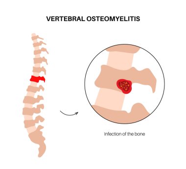 Omurga iltihabı. Enfekte olmuş omurga kemikleri, inziva ve acı. Enfeksiyon kan dolaşımından omurgaya yayılır. Klinikteki doktorla danışma, tıbbi düz vektör çizimi