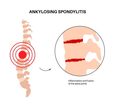 Ankylosing spondylitis. Arthritis that causes inflammation in the joints and ligaments of the spine. Inflamed and fusion vertebrae in the spinal column. Hip and lower back pain vector illustration clipart