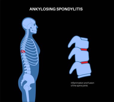 Ankylosing spondilit. Artrit, omurga eklemlerinde ve bağlarında iltihaplanmaya neden olur. Omurgada iltihaplı ve füzyon omurları var. Kalça ve bel ağrısı vektörü çizimi