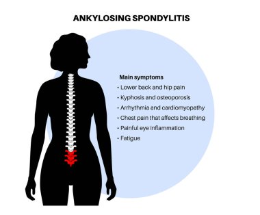 Ankylosing spondilit. Artrit, omurga eklemlerinde ve bağlarında iltihaplanmaya neden olur. Omurgada iltihaplı ve füzyon omurları var. Kalça ve bel ağrısı vektörü çizimi