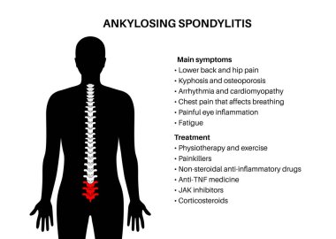 Ankylosing spondilit. Artrit, omurga eklemlerinde ve bağlarında iltihaplanmaya neden olur. Omurgada iltihaplı ve füzyon omurları var. Kalça ve bel ağrısı vektörü çizimi