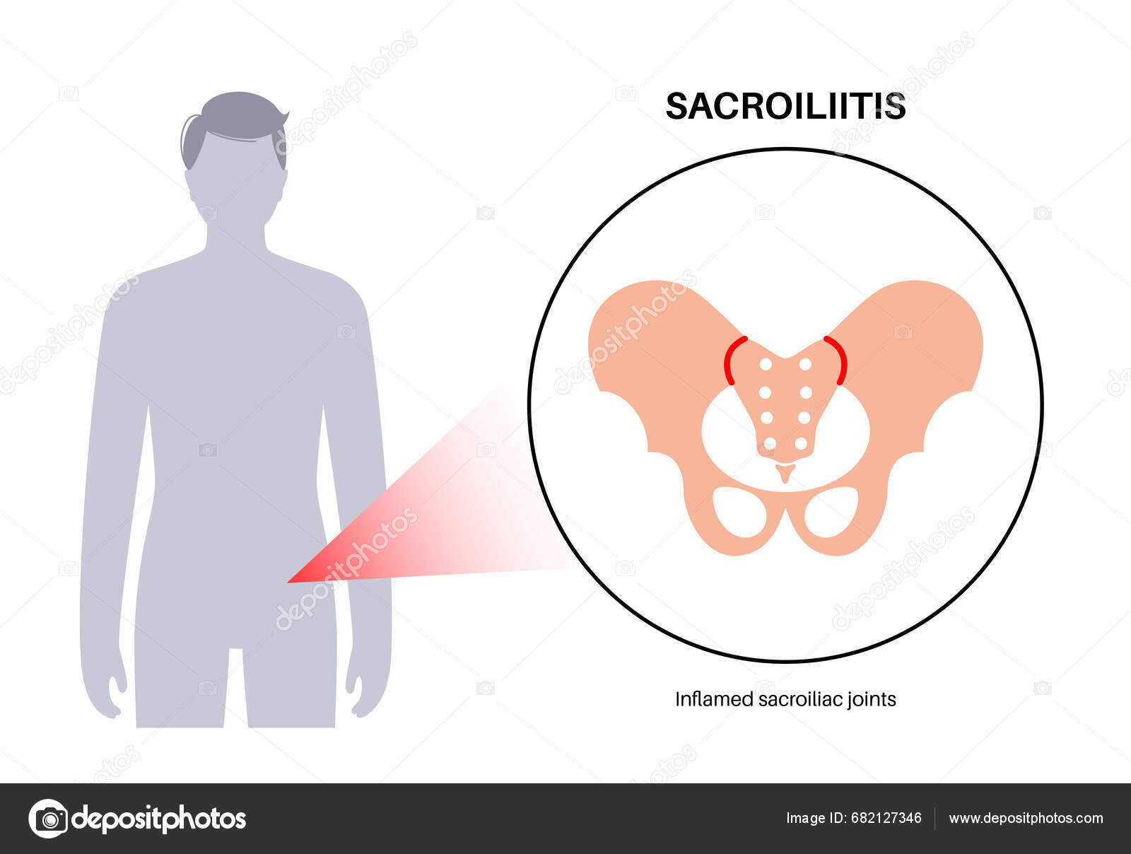 Sacroiliitis Disease Concept Inflamed Sacroiliac Joints Lower Spine ...