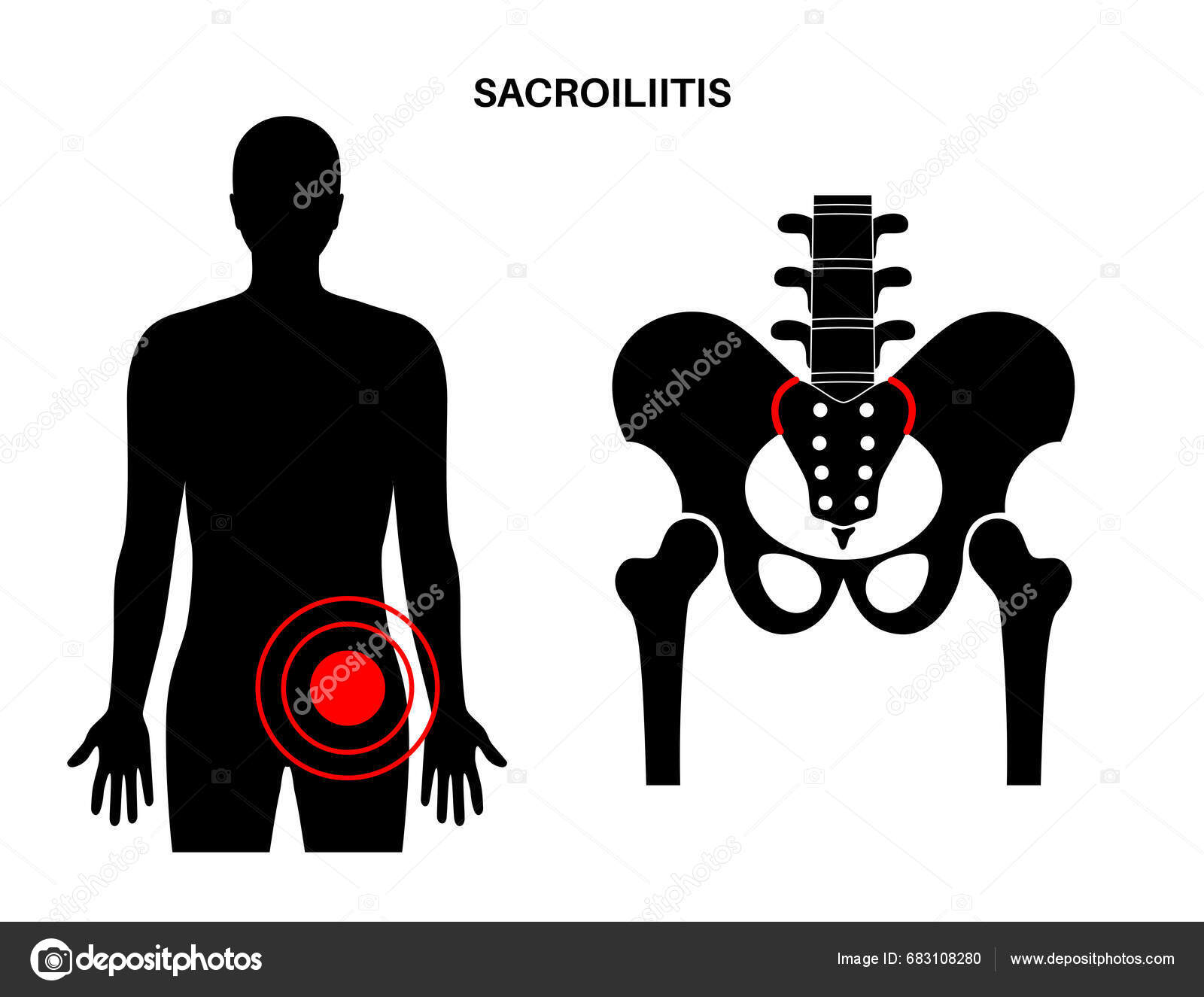 Sacroiliitis Disease Concept Inflamed Sacroiliac Joints Lower Spine ...