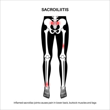 Sacroiliitis hastalığı konsepti. İltihaplı sakroiliak eklemler. Omurga altı ve leğen kemiği iltihaplanması. Ağrı, kalça veya beldeki sertlik, kuyruk sokumu problemi, anatomik vektör çizimi