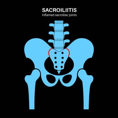 Sacroiliitis hastalığı konsepti. İltihaplı sakroiliak eklemler. Omurga altı ve leğen kemiği iltihaplanması. Ağrı, kalça veya beldeki sertlik, kuyruk sokumu problemi, anatomik vektör çizimi