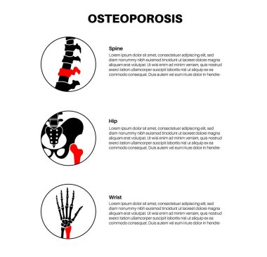 Kemik erimesi hastalığı posteri. Omurga, bilek ve kalça kemiğinde sistemik iskelet bozukluğu, kemik mineral yoğunluğu kaybı. Kalça kırığı riski artıyor. Kemik dokusu düz vektör çiziminin bozulması
