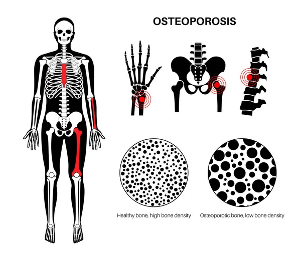 stock vector Osteoporosis disease poster. Systemic skeletal disorder of spine, wrist, and femur, loss of bone mineral density. Increased risk of hip fracture. Deterioration of bone tissue flat vector illustration