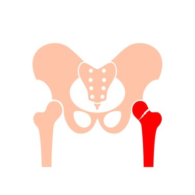 Kalça kemiği kırığı posteri. Bacak sakatlığı konsepti. Kırık uyluk kemiği, sistemik iskelet bozukluğu, mineral yoğunluğu kaybı, osteoporoz hastalığı. Kemik dokusunun çözünmesi x ışını düz vektör çizimi