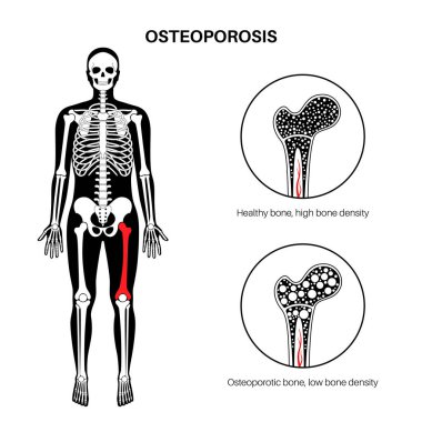 Kemik erimesi hastalığı. Sistemli iskelet bozukluğu, kemik yoğunluğu kaybı. İnsan vücudunda normal ve sağlıksız kemikler. Kırılma riski çok yüksek. Kemik dokusu vektörünün çözünmesi düz illüstrasyon