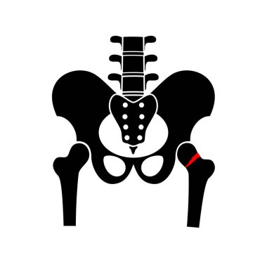 Kalça kemiği kırığı posteri. Bacak sakatlığı konsepti. Kırık uyluk kemiği, sistemik iskelet bozukluğu, mineral yoğunluğu kaybı, osteoporoz hastalığı. Kemik dokusunun çözünmesi x ışını düz vektör çizimi