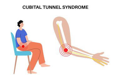 Kübital tünel sendromu. Dirsek bölgesindeki dirsek sinirine basınç uygula, çek ve gerdir. Üst uzuvları etkileyen yaygın nöropati, kollardaki ağrı anatomik vektör çizimi