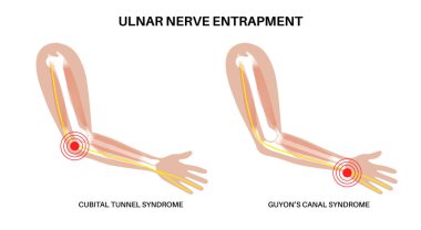 Ulnar sinir tuzağı. Cubital tünel sendromu ve Guyons kanal sendromu. Dirsek ve bilek bölgelerindeki dirsek sinirlerinde baskı ya da çekme. Kol anatomik vektör illüstrasyonunda ağrı