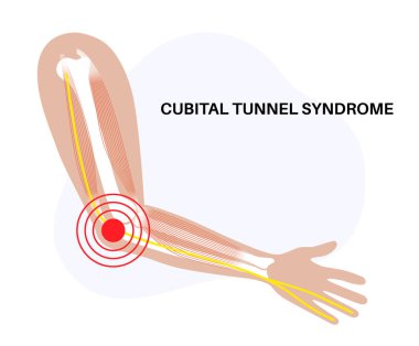 Kübital tünel sendromu. Dirsek bölgesindeki dirsek sinirine basınç uygula, çek ve gerdir. Üst uzuvları etkileyen yaygın nöropati, kollardaki ağrı anatomik vektör çizimi