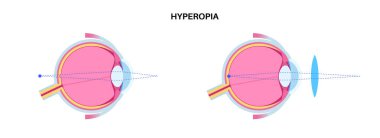 Uzağı görememe hastalığı posteri. Hiperopya ya da uzun görüş kırılma hatası konsepti, bulanık görme sorunu. İnsan gözü, lens ve retina anatomisi, hipermetrop tıbbi vektör çizimi