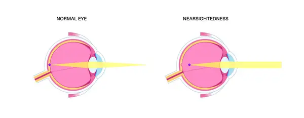 stock vector Nearsightedness eye disease poster. Myopia or short sightedness refractive error concept, problem of blurred vision. Anatomy of human eye infographic, lens and retina medical flat vector illustration