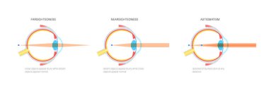 Miyopya ve hiperopi göz hastalığı anatomik poster. Miyopluk ve hipermetrop kavramı. Dar görüşlülük, uzun görüş bozukluğu. Refraktif hatalar tıbbi düz vektör çizimi