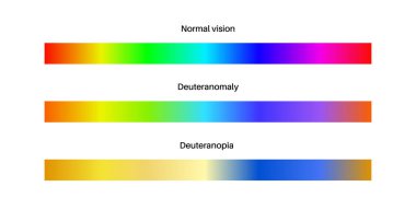 Deuteranoy, deuteranopia ve normal görme, renk körlüğü bilgisi. İnsan görüşü eksikliği konsepti. Renkler, parlaklık ve düz vektör illüstrasyonunun yoğunluğu arasındaki fark
