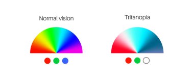 Tritanopia vision, color blindness infographic. Human vision deficiency concept. Difference between colors, brightness and intensity of shades. Eye abnormality flat vector illustration clipart