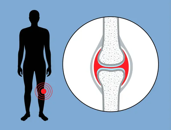 Hemarthrosis Disease Medical Poster Bleeding Synovial Joints Physical Examination Orthopedic — Stock Vector