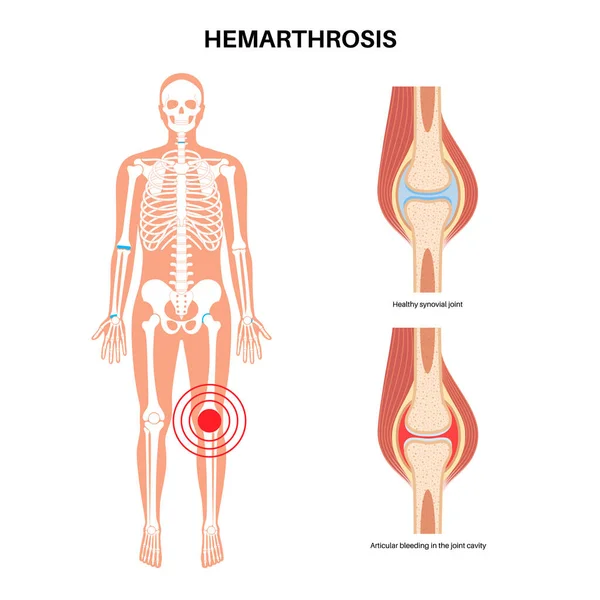 Hemarthrosis Disease Medical Poster Bleeding Synovial Joints Physical Examination Orthopedic — Stock Vector
