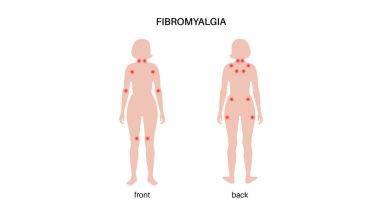 Kadın vücudunda fibromiyalji. Eklem kaslarında, yorgunlukta ve bilişsel semptomlarda kronik yaygın ağrı. Kas iskeleti hastalığı. Kadın siluetinde kırmızı noktalar tıbbi düz vektör çizimi.