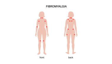 Fibromyalgia in the female body. Chronic widespread pain in joints muscles, fatigue and cognitive symptoms. Musculoskeletal disease. Red points in woman silhouette medical flat vector illustration. clipart