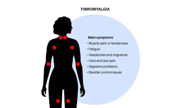 Kadın vücudunda fibromiyalji. Eklem kaslarında, yorgunlukta ve bilişsel semptomlarda kronik yaygın ağrı. Kas iskeleti hastalığı. Kadın siluetinde kırmızı noktalar tıbbi düz vektör çizimi.