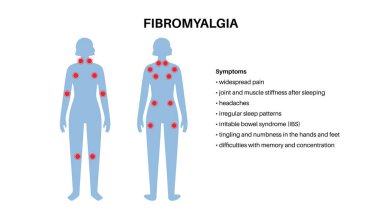 Kadın vücudunda fibromiyalji. Eklem kaslarında, yorgunlukta ve bilişsel semptomlarda kronik yaygın ağrı. Kas iskeleti hastalığı. Kadın siluetinde kırmızı noktalar tıbbi düz vektör çizimi.