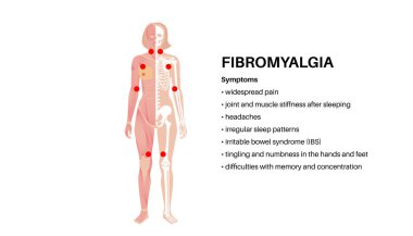 Kadın vücudunda fibromiyalji. Eklem kaslarında, yorgunlukta ve bilişsel semptomlarda kronik yaygın ağrı. Kas iskeleti hastalığı. Kadın siluetinde kırmızı noktalar tıbbi düz vektör çizimi.