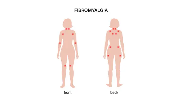 Fibromyalgie Weiblichen Körper Chronische Schmerzen Der Gelenkmuskulatur Müdigkeit Und Kognitive lizenzfreie Stockvektoren