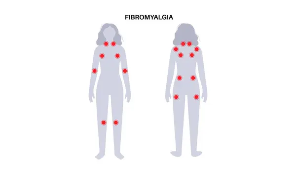 Fibromyalgie Weiblichen Körper Chronische Schmerzen Der Gelenkmuskulatur Müdigkeit Und Kognitive Stockillustration