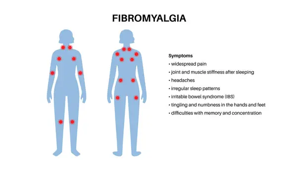 Fibromyalgie Weiblichen Körper Chronische Schmerzen Der Gelenkmuskulatur Müdigkeit Und Kognitive Vektorgrafiken