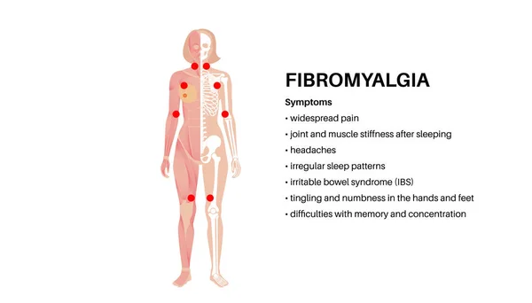 Fibromialgia Cuerpo Femenino Dolor Crónico Generalizado Los Músculos Las Articulaciones Ilustraciones De Stock Sin Royalties Gratis