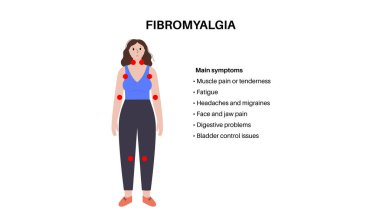 Kadın vücudunda fibromiyalji. Eklem kaslarında, yorgunlukta ve bilişsel semptomlarda kronik yaygın ağrı. Kas iskeleti hastalığı. Kadın siluetinde kırmızı noktalar tıbbi düz vektör çizimi.
