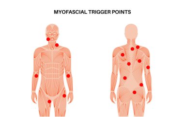 Miyofasyal tetikleyici tıbbi afiş. MTP konsepti. Çizgili kas düğümlerindeki aşırı hassas noktalar erkek siluetinde. İnsan vücudu düz vektör çizimindeki hassas bölgelerde kırmızı noktalar